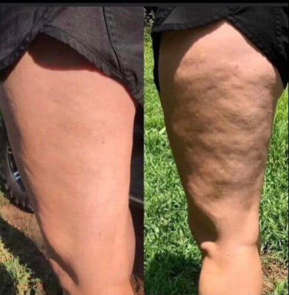 SmoothRise™ - Anti-cellulite Massage Oil