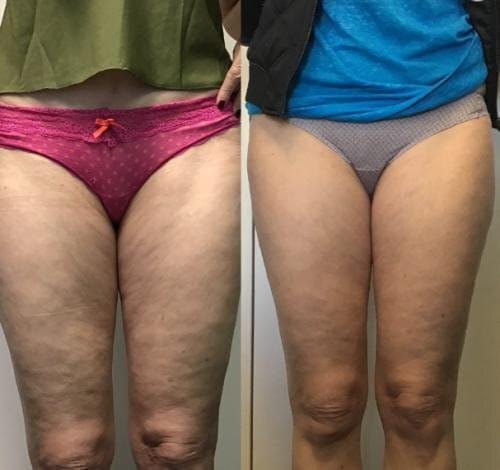 NovaPureHealth™ - Anti-cellulite Massage Oil