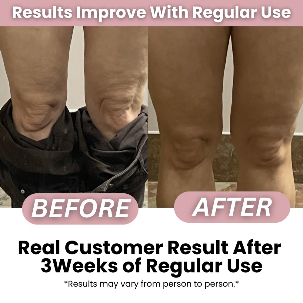 SmoothRise™ - Anti-cellulite Massage Oil