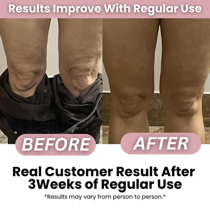 SmoothRise™ - Anti-cellulite Massage Oil